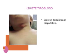 QUISTE TIROGLOSO
• Exéresis quirúrgica al
diagnóstico.
 