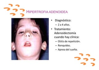HIPERTROFIA ADENOIDEA
• Diagnóstico:
– 2 a 4 años.
• Tratamiento:
Adenoidectomía
cuando hay clínica:
– Otitis de repetición.
– Ronquidos.
– Apnea del sueño.
 