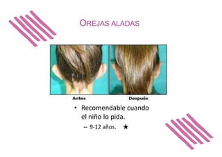 OREJAS ALADAS
• Recomendable cuando
el niño lo pida.
– 9-12 años. ★
 