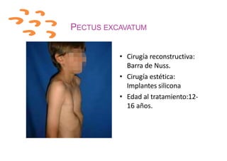 PECTUS EXCAVATUM
• Cirugía reconstructiva:
Barra de Nuss.
• Cirugía estética:
Implantes silicona
• Edad al tratamiento:12-
16 años.
 