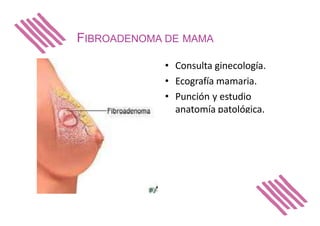 FIBROADENOMA DE MAMA
• Consulta ginecología.
• Ecografía mamaria.
• Punción y estudio
anatomía patológica.
 