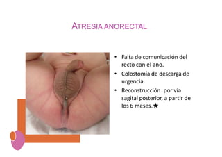 ATRESIA ANORECTAL
• Falta de comunicación del
recto con el ano.
• Colostomía de descarga de
urgencia.
• Reconstrucción por vía
sagital posterior, a partir de
los 6 meses.★
 