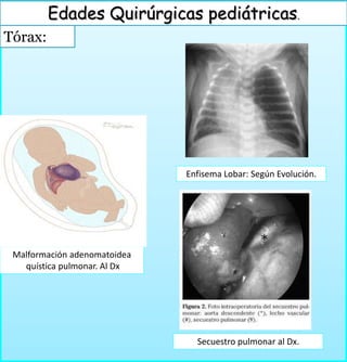 Tórax:
Edades Quirúrgicas pediátricas.
Malformación adenomatoidea
quística pulmonar. Al Dx
Enfisema Lobar: Según Evolución.
Secuestro pulmonar al Dx.
 