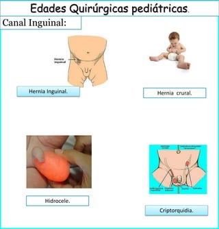 Canal Inguinal:
Edades Quirúrgicas pediátricas.
Hernia crural.Hernia Inguinal.
Criptorquidia.
Hidrocele.
 