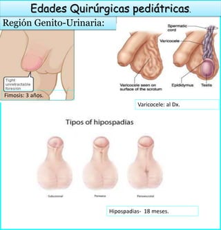 Región Genito-Urinaria:
Edades Quirúrgicas pediátricas.
Fimosis: 3 años.
Varicocele: al Dx.
Hipospadias- 18 meses.
 
