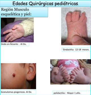 Región Musculo
esquelética y piel:
Edades Quirúrgicas pediátricas.
Dedo en Resorte : Al Dx.
polidactilia : Mayor 1 año.
Sindactilia: 12-18 meses.
Granulomas piogenicos. Al Dx.
 