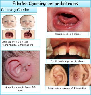 Cabeza y Cuello:
Edades Quirúrgicas pediátricas.
Labio Leporino. 3-6meses
Fisura Palatina. 3 meses al año.
Anquiloglosia: 3-6 meses.
Frenillo labial superior: 8-10 anos.
Apéndice preauriculares: 1-6
meses.
Senos preauriculares: Al Diagnostico.
 