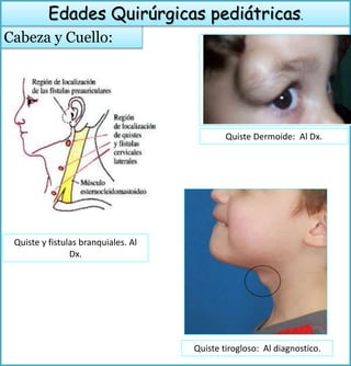 Cabeza y Cuello:
Edades Quirúrgicas pediátricas.
Quiste y fistulas branquiales. Al
Dx.
Quiste Dermoide: Al Dx.
Quiste tirogloso: Al diagnostico.
 