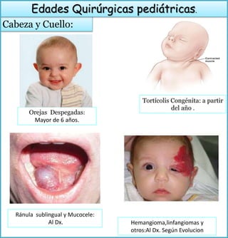 Cabeza y Cuello:
Edades Quirúrgicas pediátricas.
Ránula sublingual y Mucocele:
Al Dx.
Orejas Despegadas:
Mayor de 6 años.
Hemangioma,linfangiomas y
otros:Al Dx. Según Evolucion
Tortícolis Congénita: a partir
del año .
 