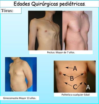 Tórax:
Edades Quirúrgicas pediátricas.
Ginecomastia Mayor 13 años.
Pectus: Mayor de 7 años.
Politelia:a cualquier Edad
 