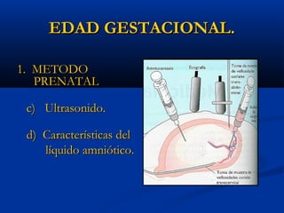 EDAD GESTACIONAL.

1. METODO
   PRENATAL

 c) Ultrasonido.

 d) Características del
    líquido amniótico.
 