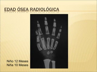 Edad osea | PPT