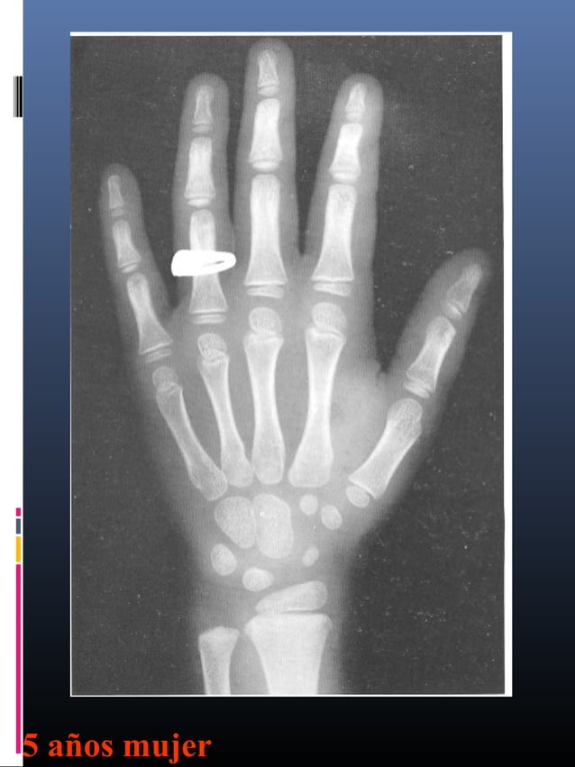 Edad osea de las niñas | PPT