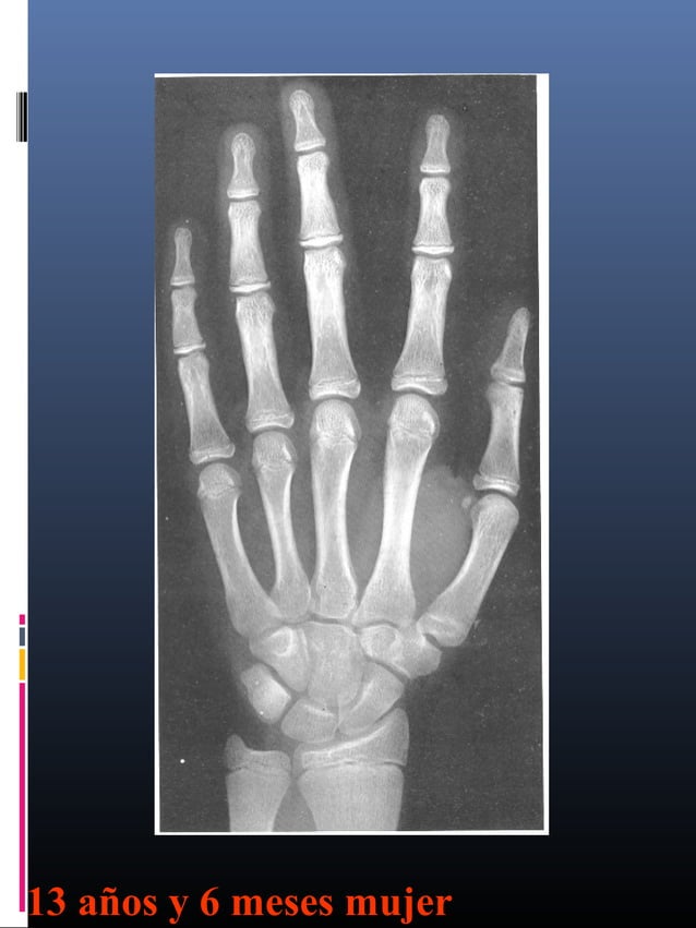 Edad osea de las niñas | PPT