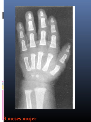 Edad osea de las niñas | PPT