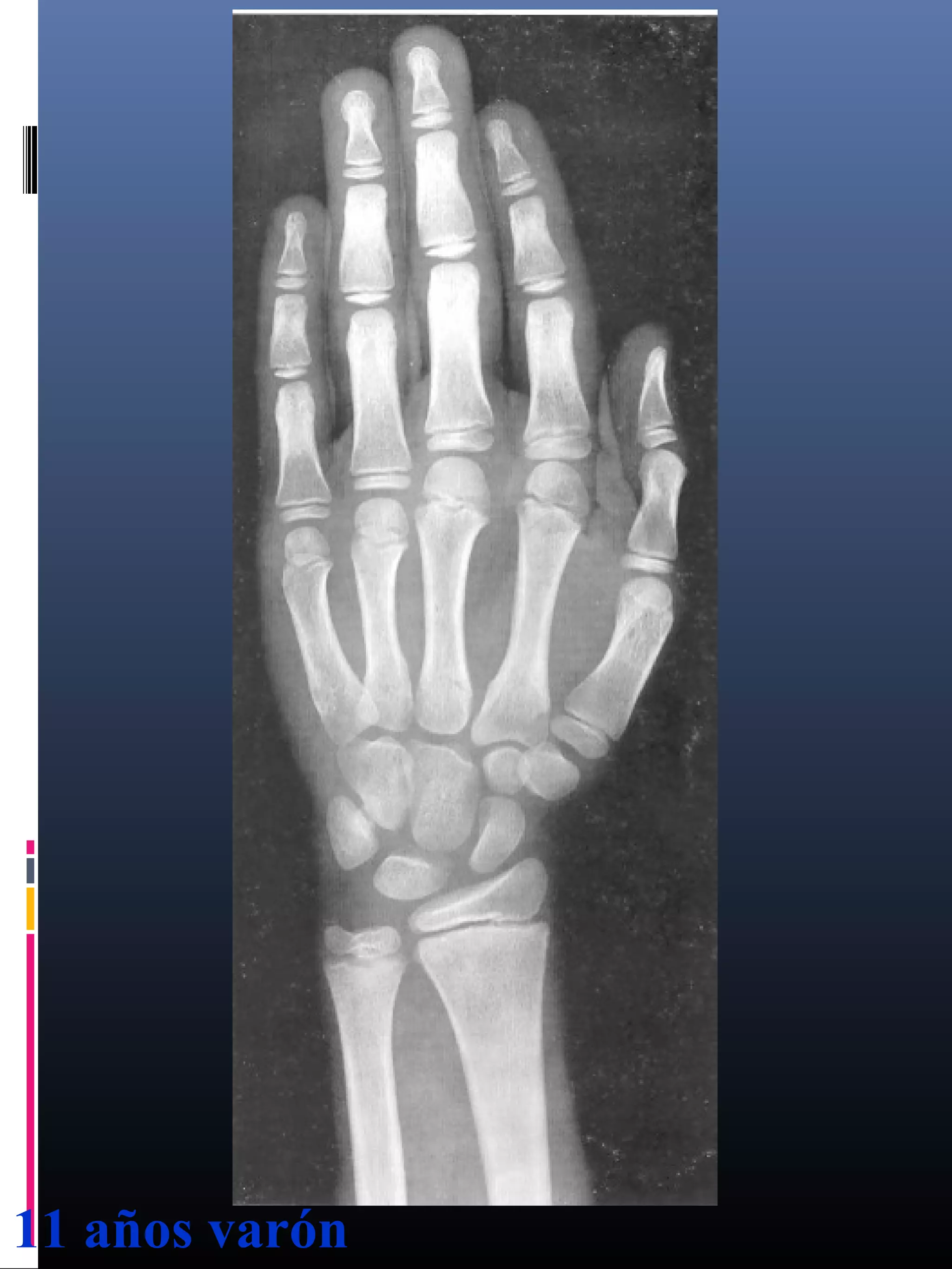 Edad osea en los niños | PPT