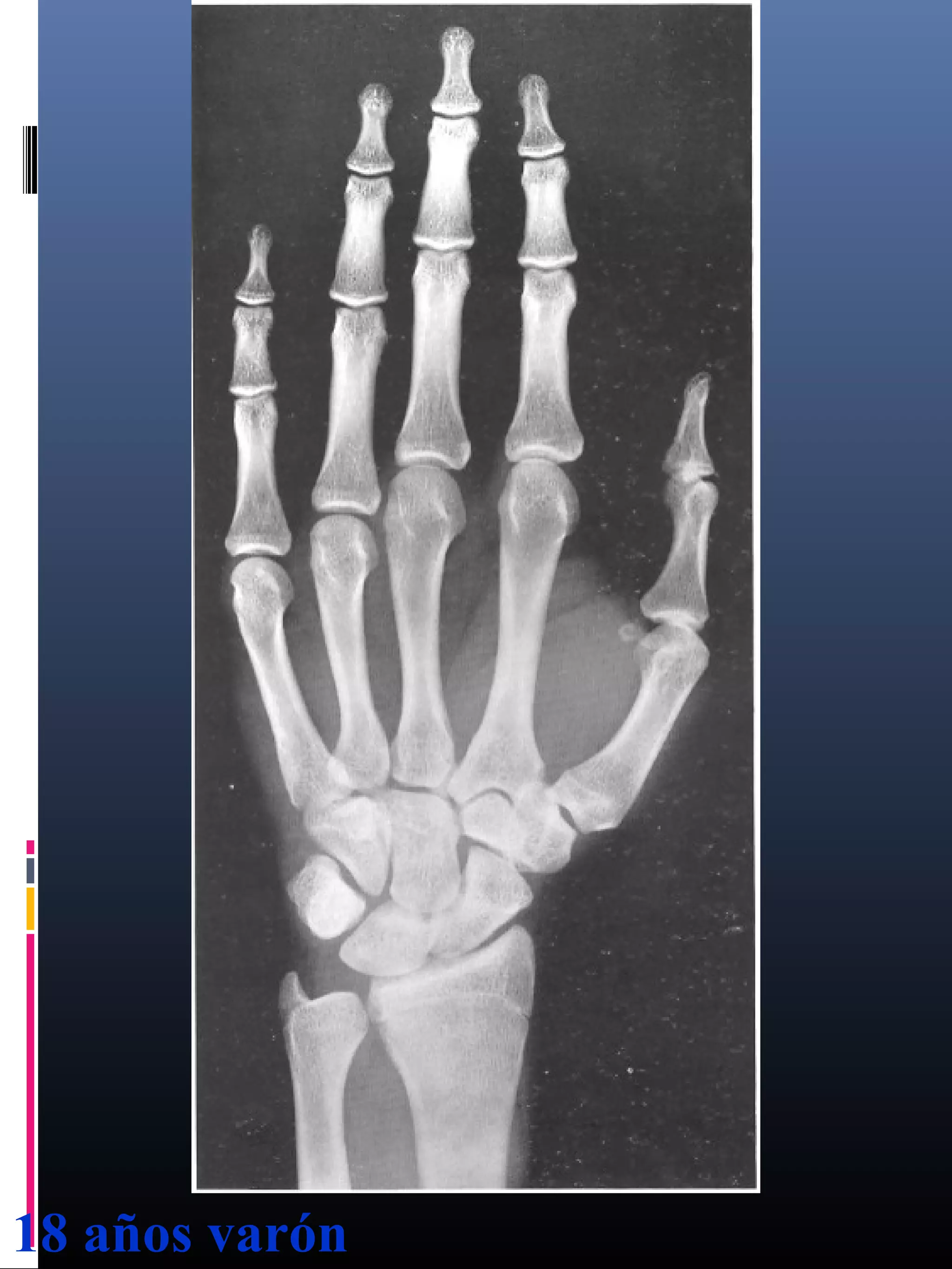 Edad osea en los niños | PPT