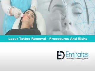 Laser Tattoo Removal - Procedures And Risks
 