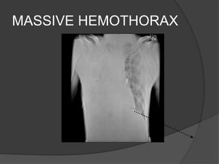 MASSIVE HEMOTHORAX
 