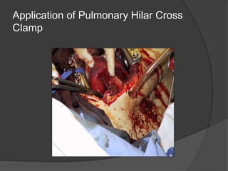 Application of Pulmonary Hilar Cross
Clamp
 