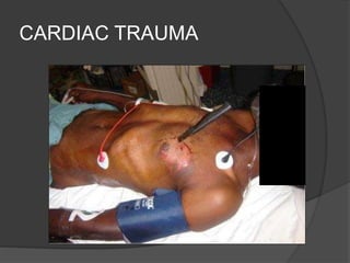 CARDIAC TRAUMA
 