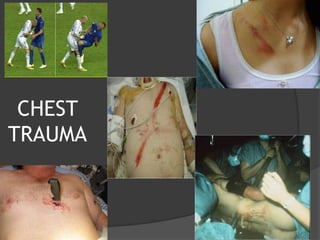 CHEST
TRAUMA
 