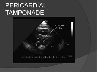 PERICARDIAL
TAMPONADE
 