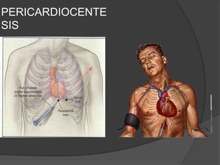 PERICARDIOCENTE
SIS
 