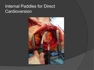 Internal Paddles for Direct
Cardioversion
 