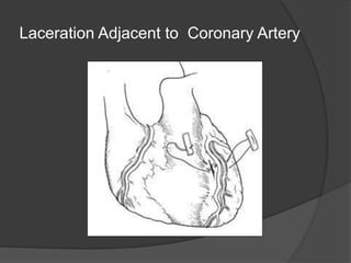 Laceration Adjacent to Coronary Artery
 