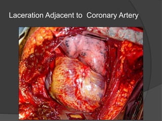 Laceration Adjacent to Coronary Artery
 
