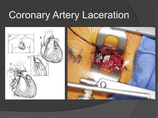 Coronary Artery Laceration
 