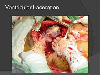 Ventricular Laceration
 