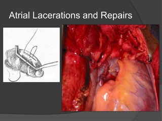 Atrial Lacerations and Repairs
 