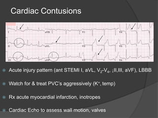 Cardiac Contusions
 Acute injury pattern (ant STEMI I, aVL, V2-V4, ↓II,III, aVF), LBBB
 Watch for & treat PVC’s aggressively (K+, temp)
 Rx acute myocardial infarction, inotropes
 Cardiac Echo to assess wall motion, valves
 