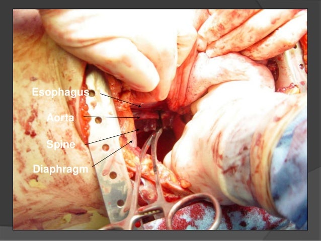 Exsanguination And Avulsion Of The Right Internal Thoracic Artery Chest Trauma