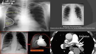 Approach to chest pain | PDF