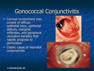Marginal Infiltrates Ed&cornea lecture fatima | PPT