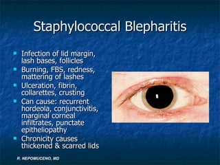 Marginal Infiltrates Ed&cornea lecture fatima | PPT