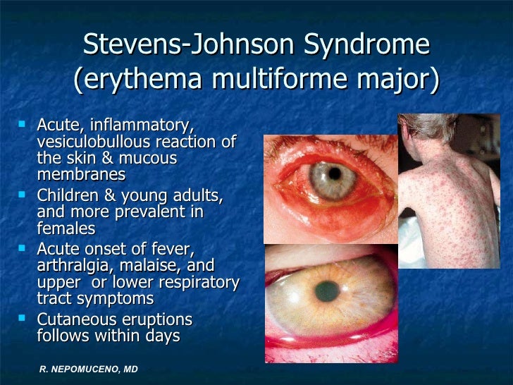 Erythema Multiforme And Stevens Johnson Syndrome Ed&cornea lecture fatima