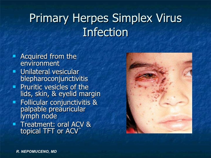 Herpes Simplex Eyelid Treatment Herpes simplex keratitis & herpes zoster opthalmicus Overall