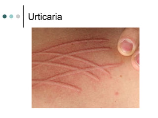 Urticaria
 