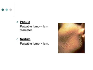    Papule
    Palpable lump <1cm
    diameter.

   Nodule
    Palpable lump >1cm.
 