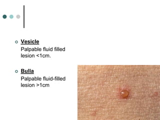    Vesicle
    Palpable fluid filled
    lesion <1cm.

   Bulla
    Palpable fluid-filled
    lesion >1cm
 