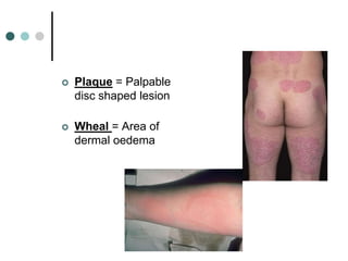    Plaque = Palpable
    disc shaped lesion

   Wheal = Area of
    dermal oedema
 