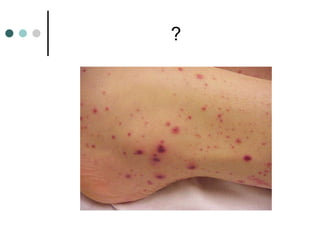Arcuate Rash