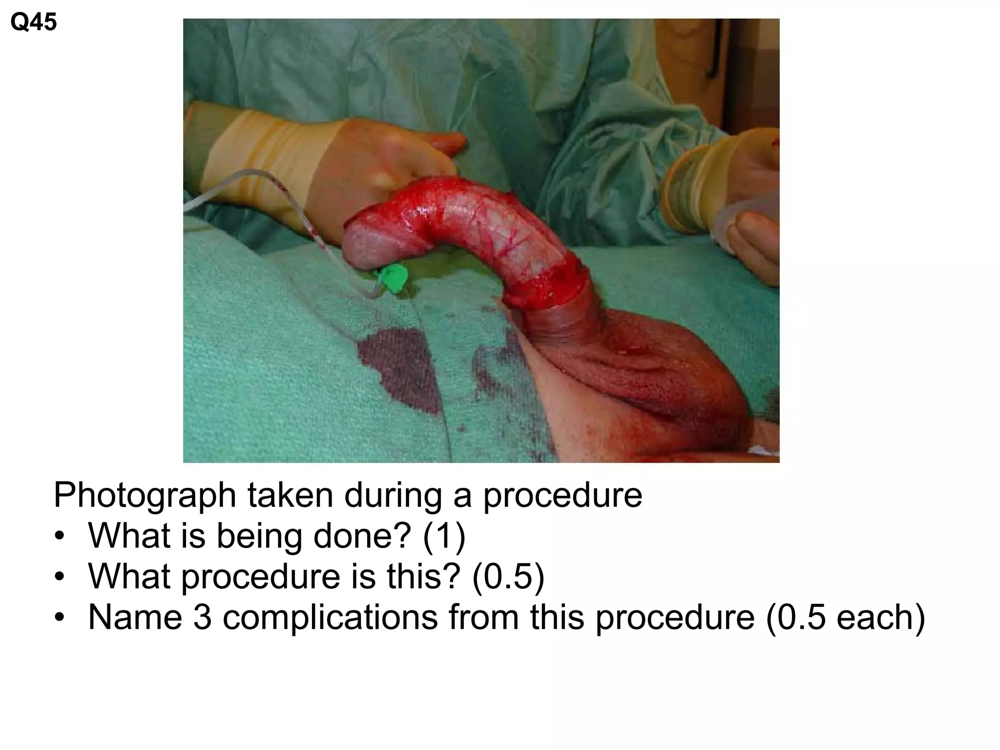 Photograph taken during a procedure
• What is being done? (1)
• What procedure is this? (0.5)
• Name 3 complications from this procedure (0.5 each)
Q45
 
