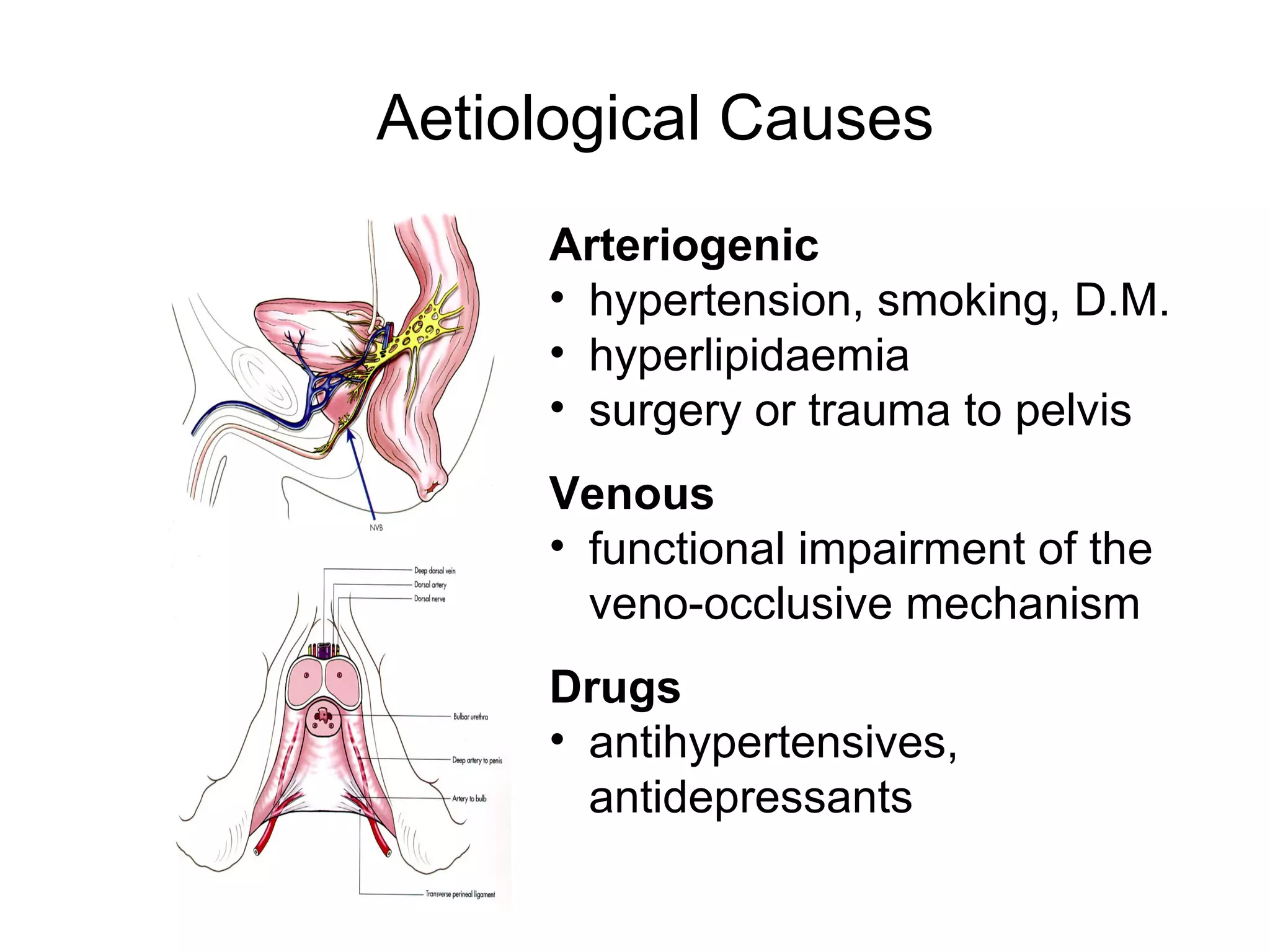 Aetiological Causes
Arteriogenic
• hypertension, smoking, D.M.
• hyperlipidaemia
• surgery or trauma to pelvis
Venous
• functional impairment of the
veno-occlusive mechanism
Drugs
• antihypertensives,
antidepressants
 