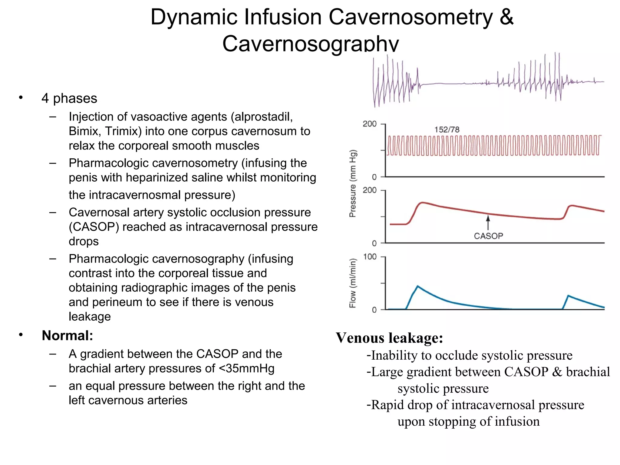 Dynamic Infusion Cavernosometry &
Cavernosography
• 4 phases
– Injection of vasoactive agents (alprostadil,
Bimix, Trimix) into one corpus cavernosum to
relax the corporeal smooth muscles
– Pharmacologic cavernosometry (infusing the
penis with heparinized saline whilst monitoring
the intracavernosmal pressure)
– Cavernosal artery systolic occlusion pressure
(CASOP) reached as intracavernosal pressure
drops
– Pharmacologic cavernosography (infusing
contrast into the corporeal tissue and
obtaining radiographic images of the penis
and perineum to see if there is venous
leakage
• Normal:
– A gradient between the CASOP and the
brachial artery pressures of <35mmHg
– an equal pressure between the right and the
left cavernous arteries
Venous leakage:
-Inability to occlude systolic pressure
-Large gradient between CASOP & brachial
systolic pressure
-Rapid drop of intracavernosal pressure
upon stopping of infusion
 