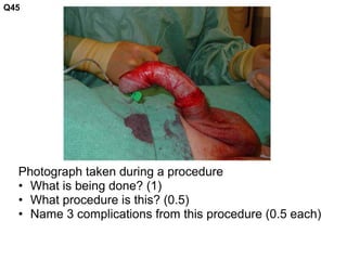 Photograph taken during a procedure
• What is being done? (1)
• What procedure is this? (0.5)
• Name 3 complications from this procedure (0.5 each)
Q45
 